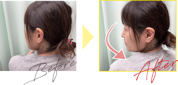 栗東市ご在住の肩と背中の痛みでお悩みの方の改善事例